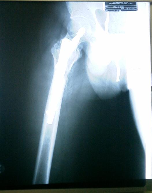 another 6-week xray, plus my zipper