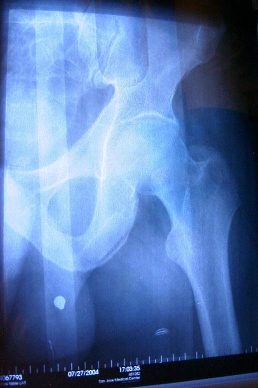 unbroken left femur